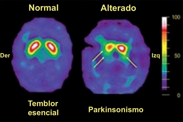 Un nuevo test que permite detectar el Parkinson y el Alzheimer – Nexofin